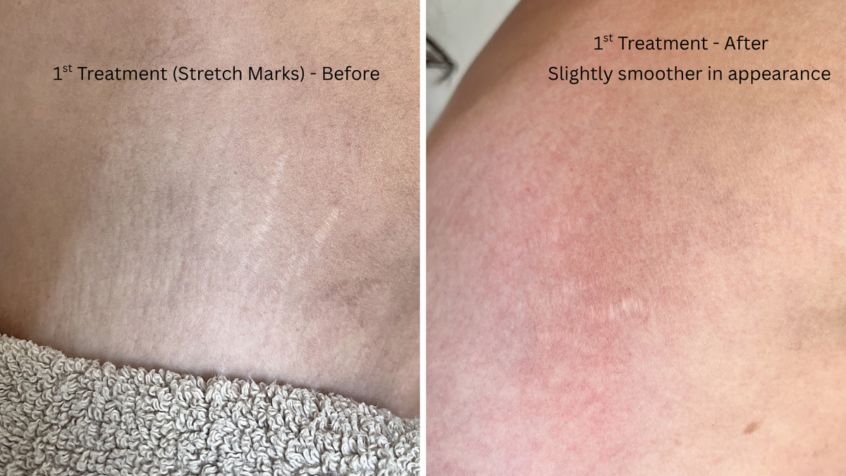 Micro-needling (skin rejuvenation)