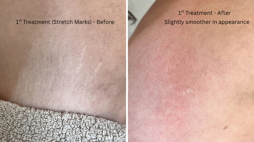 Micro-needling (skin rejuvenation)